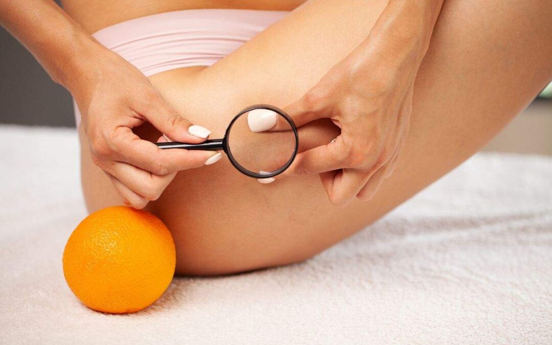 Does Fat Cause Cellulite?