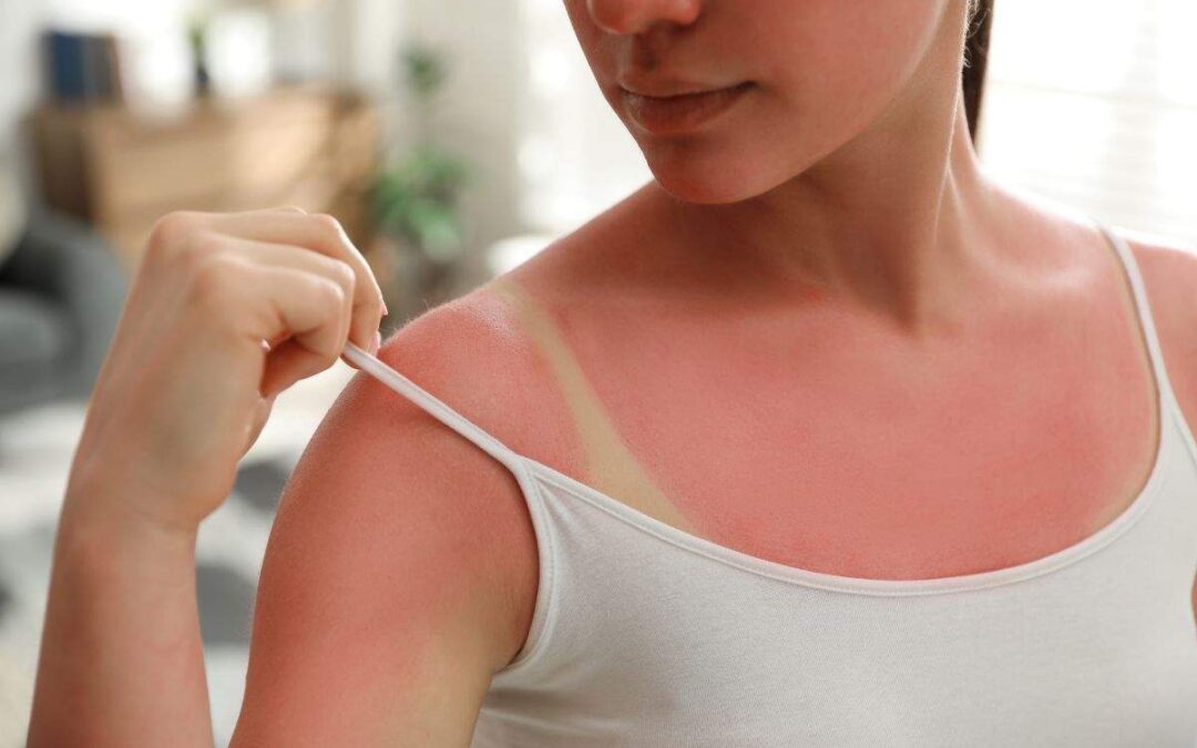 Sunburn Relief: Can UltraSlim® Help Reduce Redness and Swelling?