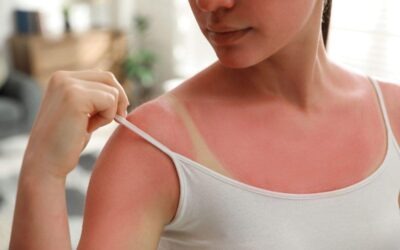 Sunburn Relief: Can UltraSlim® Help Reduce Redness and Swelling?