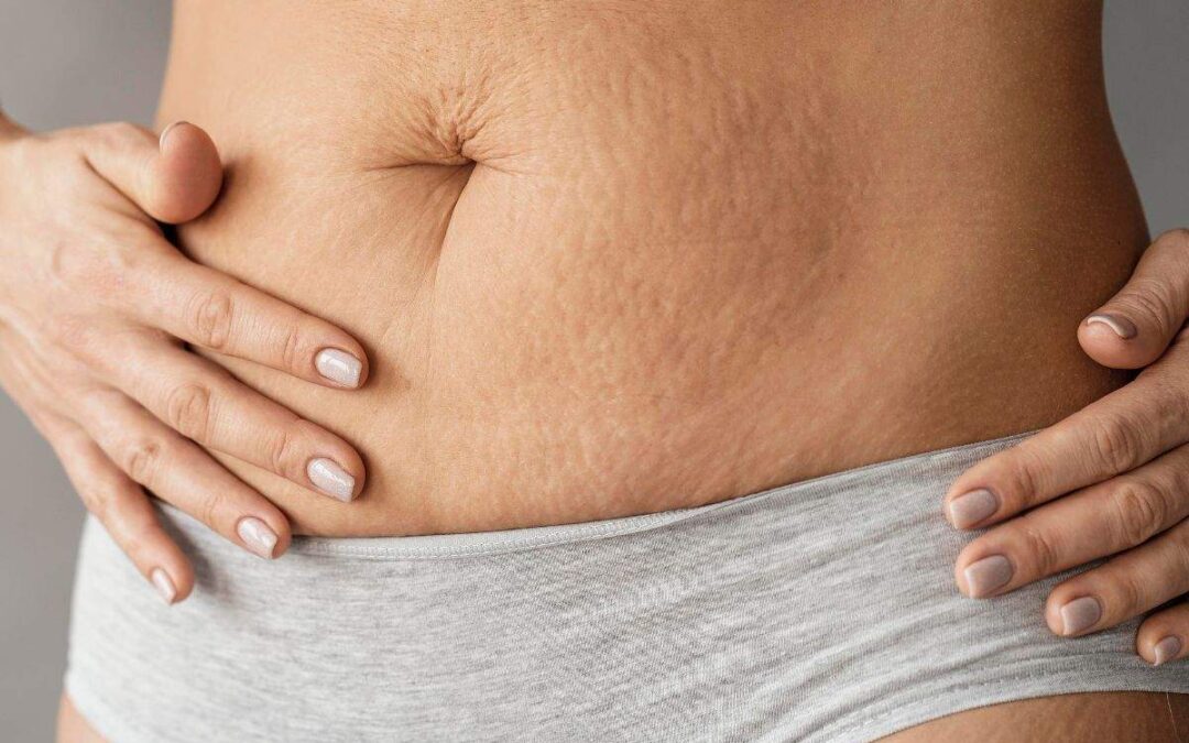 Can UltraSlim® Help Tighten Skin After Pregnancy?