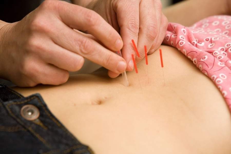 Fertility Acupuncture in Boca Raton